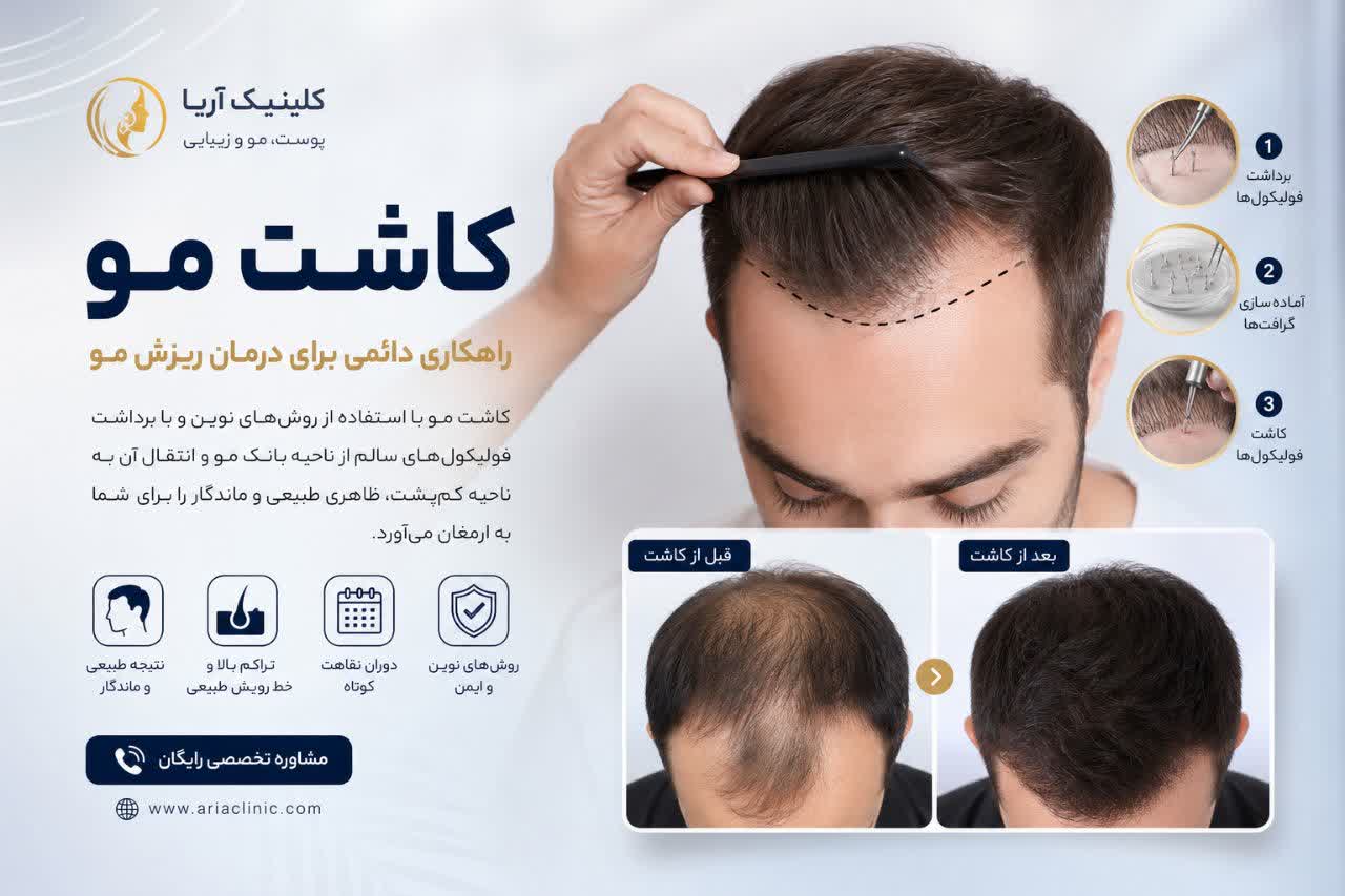 کاشت مو؛ راهنمای کامل مزایا، روش‌ها، هزینه و مراقبت‌های قبل و بعد از کاشت مو